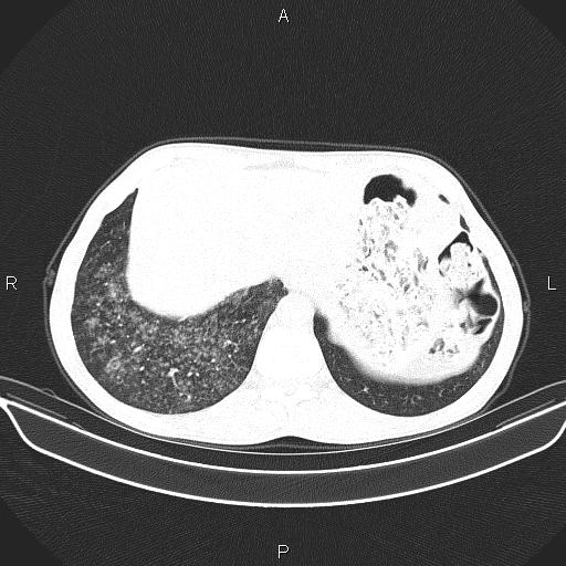 Air bronchogram in pneumonia (Radiopaedia 85719-101512 Axial lung window 59).jpg