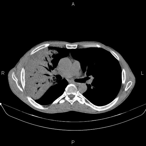 Air bronchogram in pneumonia (Radiopaedia 85719-101512 Axial non-contrast 31).jpg