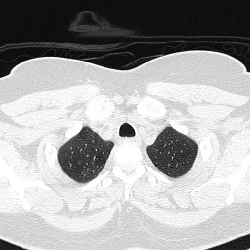 Air trapping in small airway disease (Radiopaedia 61685-69694 Axial lung window 19).jpg