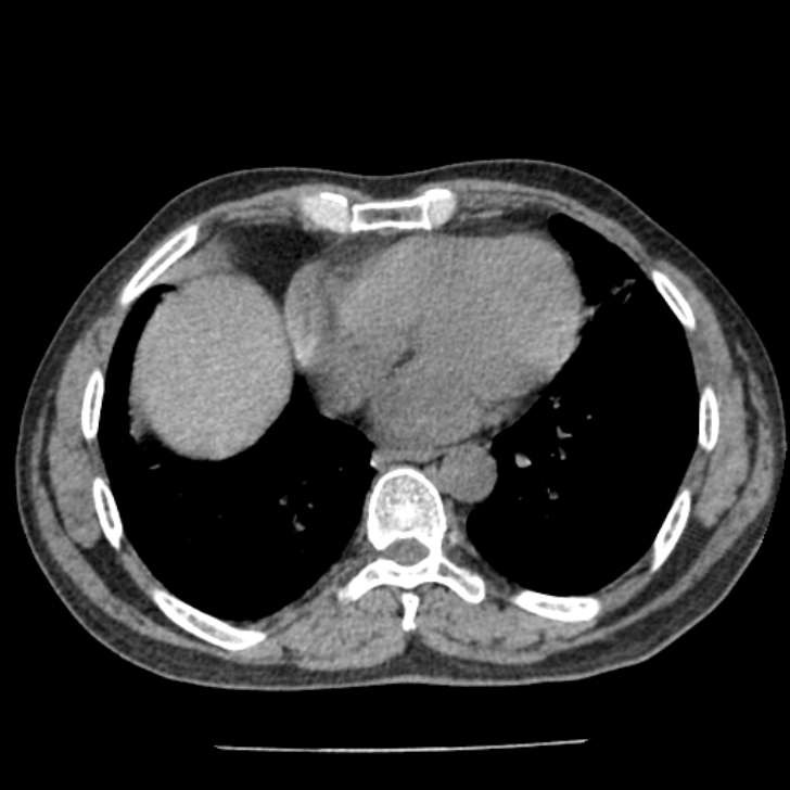 Airway foreign body in adult (Radiopaedia 85907-101779 Axial liver window 127).jpg