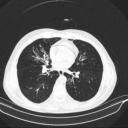 File:Allergic bronchopulmonary aspergillosis (Radiopaedia 21386-21320 Axial lung window 21).jpg