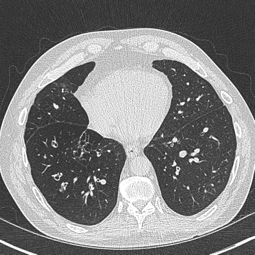 Allergic bronchopulmonary aspergillosis (Radiopaedia 44760-48571 Axial lung window 46).png