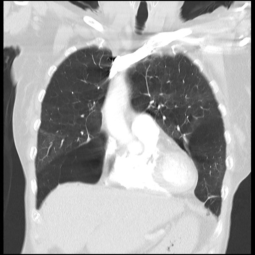 File:Alpha-1-antitrypsin deficiency (Radiopaedia 64893-73840 Coronal lung window 10).jpg