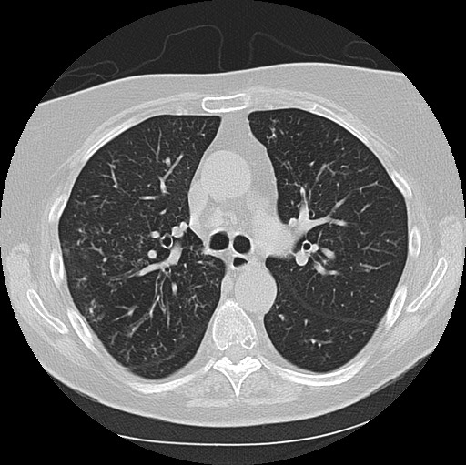 Alpha-1-antitrypsin deficiency (Radiopaedia 72058-82557 Axial lung window 27).jpg