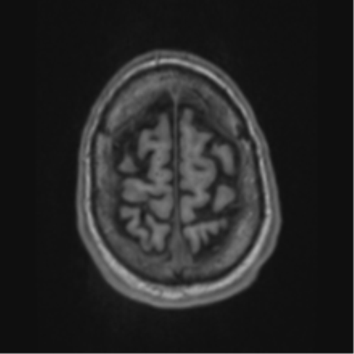 Alzheimer's disease- with apraxia (Radiopaedia 54763-61011 Axial T1 67).png