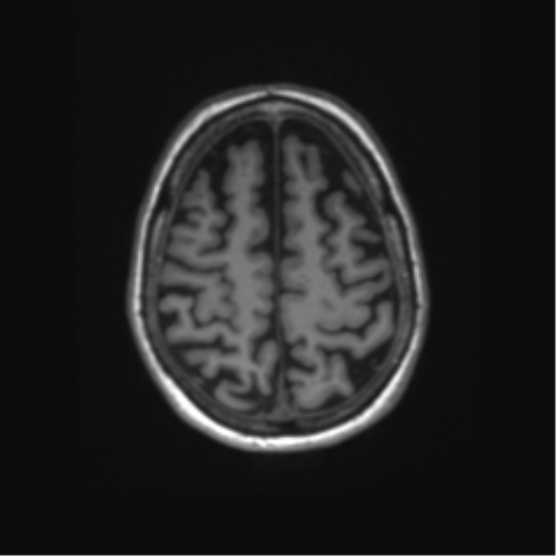 File:Alzheimer's disease (Radiopaedia 42658-45802 Axial T1 38).png