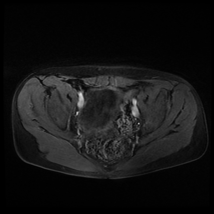 Ambiguous genitalia (Radiopaedia 69686-79643 Axial T1 C+ fat sat 24).jpg