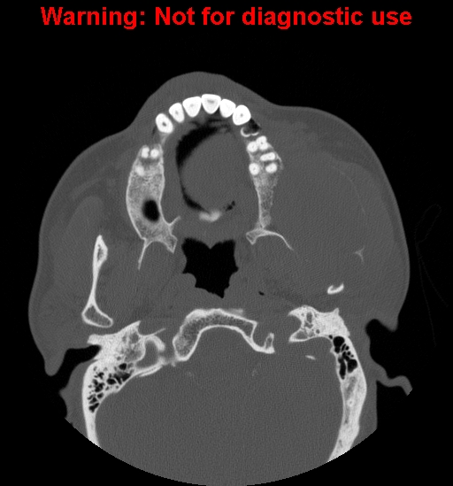 File:Ameloblastoma (Radiopaedia 13276-13280 Axial non-contrast 17).jpg