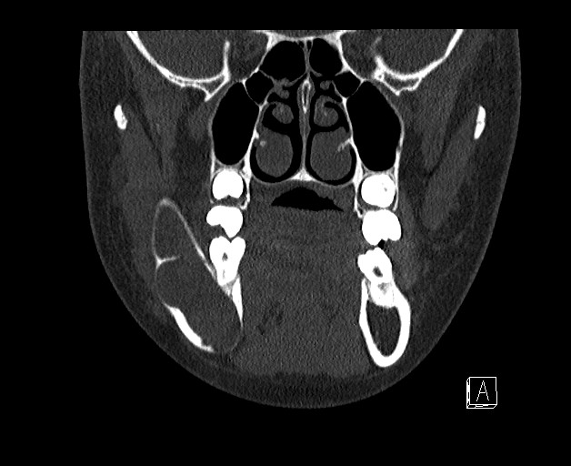 File:Ameloblastoma (Radiopaedia 26645-26793 bone window 5).jpg