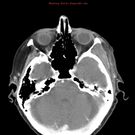 Ameloblastoma (Radiopaedia 27437-27631 A 2).jpg