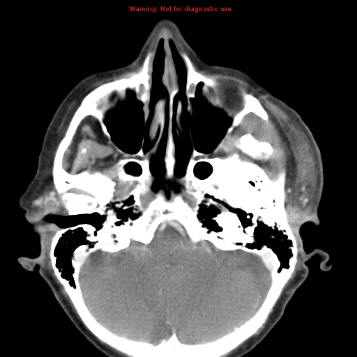 Ameloblastoma (Radiopaedia 27437-27631 A 9).jpg