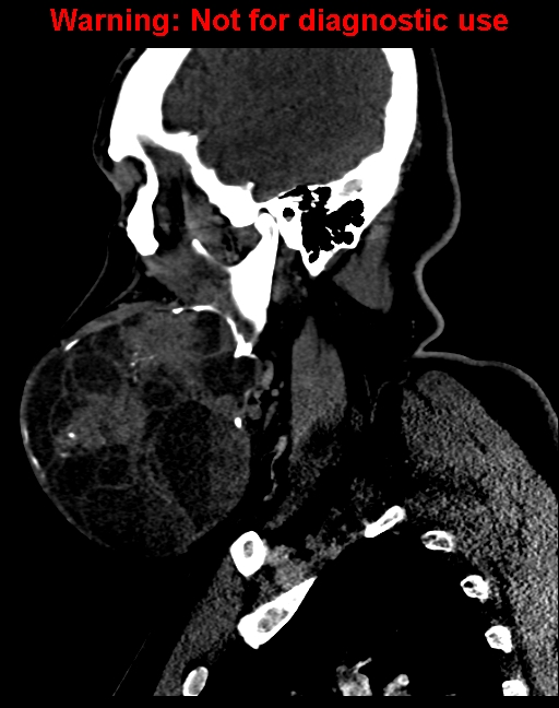 Ameloblastoma (Radiopaedia 33126-34164 F 19).jpg