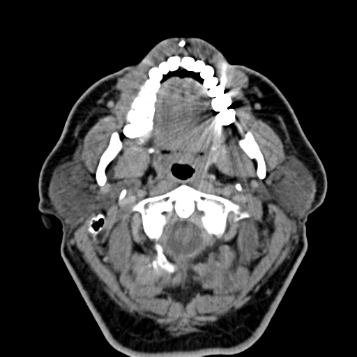 Ameloblastoma (Radiopaedia 38520-40623 Axial non-contrast 24).png