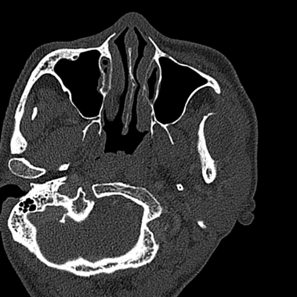Ameloblastoma (Radiopaedia 51921-57766 Axial bone window 132).jpg