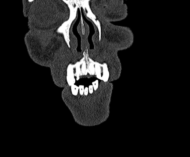 Ameloblastoma (Radiopaedia 51921-57766 Coronal bone window 16).jpg