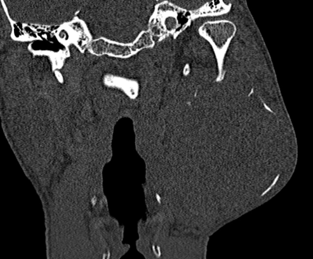 Ameloblastoma (Radiopaedia 51921-57766 Coronal bone window 190).jpg