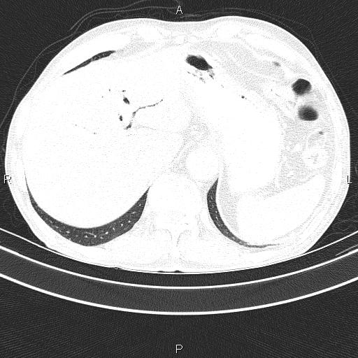 Ampullary adenocarcinoma (Radiopaedia 86093-102033 Axial lung window 51).jpg