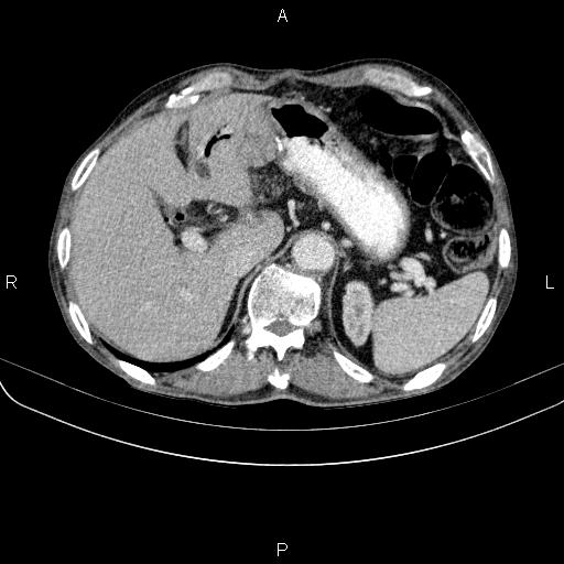 Ampullary adenocarcinoma (Radiopaedia 86093-102033 B 54).jpg