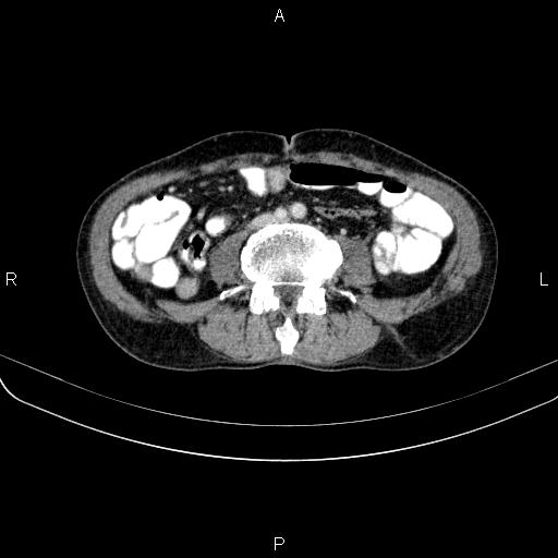 Ampullary adenocarcinoma (Radiopaedia 86093-102033 B 80).jpg