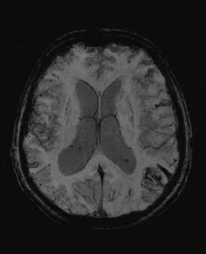 File:Amyloid angiopathy with inflammation (Radiopaedia 30360-31002 Axial SWI MIP 33).jpg