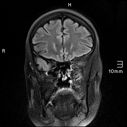 File:Amyotrophic lateral sclerosis (Radiopaedia 70821-81017 Coronal FLAIR 9).jpg
