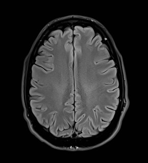 File:Amyotrophic lateral sclerosis (Radiopaedia 87352-103658 Axial FLAIR 21).jpg