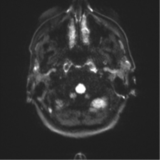 Anaplastic astrocytoma - thalamic glioma (Radiopaedia 59709-67115 Axial DWI 37).png