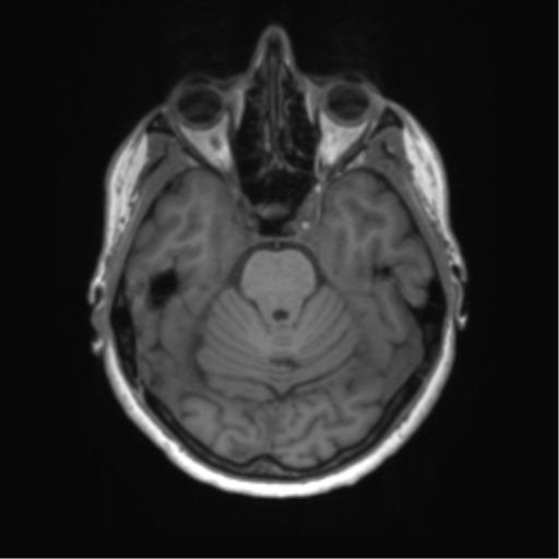 File:Anaplastic astrocytoma - thalamic glioma (Radiopaedia 59709-67115 Axial T1 1).png