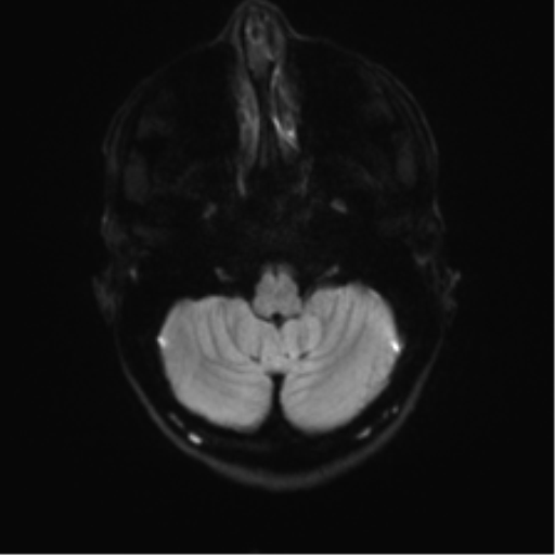Anaplastic astrocytoma IDH mutant (Radiopaedia 50046-55341 Axial DWI 32).png