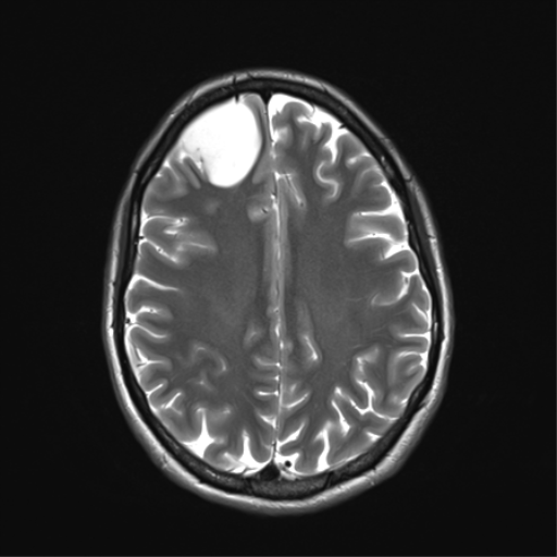 File:Anaplastic astrocytoma IDH mutant (Radiopaedia 50046-55341 Axial T2 27).png