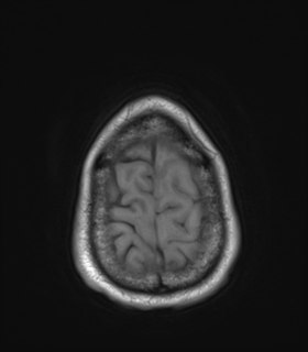 Anaplastic astrocytoma IDH wild-type (Radiopaedia 49984-55273 Axial T1 51).png