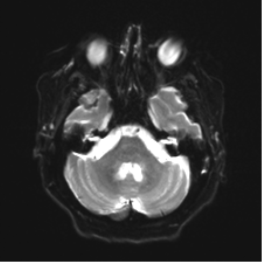 Anaplastic astrocytoma IDH wild-type (pseudoprogression) (Radiopaedia 42209-45279 Axial DWI 7).png