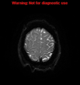 File:Anaplastic ganglioglioma (Radiopaedia 44921-48831 Axial DWI 59).jpg