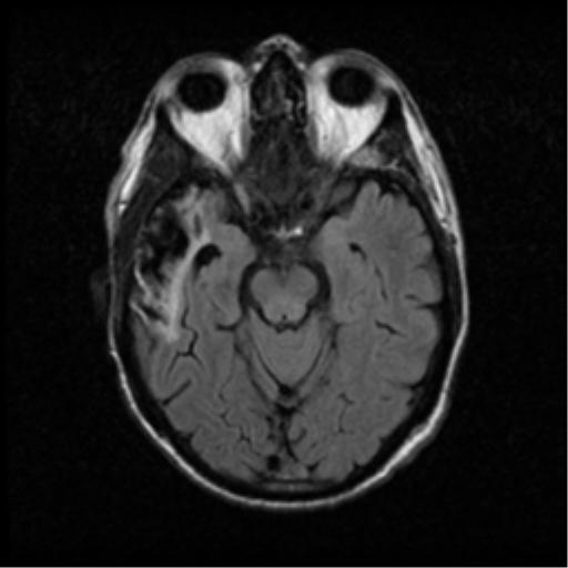 File:Anaplastic meningioma with recurrence (Radiopaedia 34452-35789 Axial FLAIR 9).png