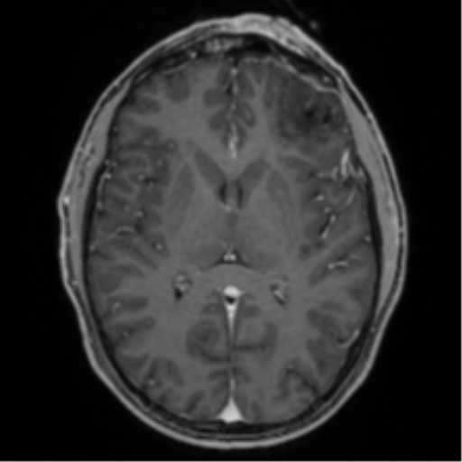 Anaplastic oligodendroglioma with skull fracture (Radiopaedia 74831-85845 Axial T1 C+ fat sat 33).png