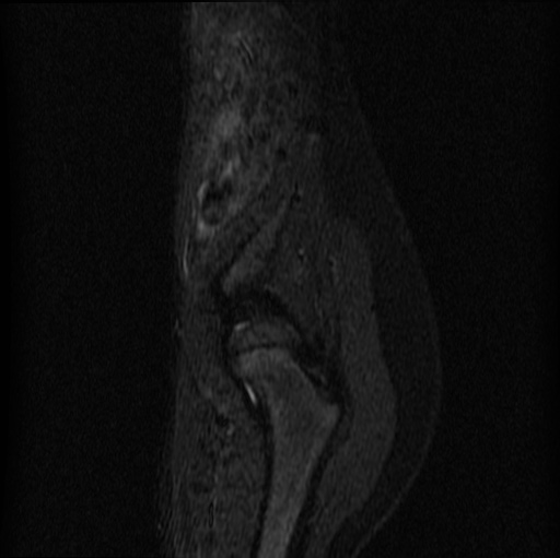 File:Aneurysmal bone cyst - sacrum (Radiopaedia 65190-74196 Sagittal STIR 3).jpg