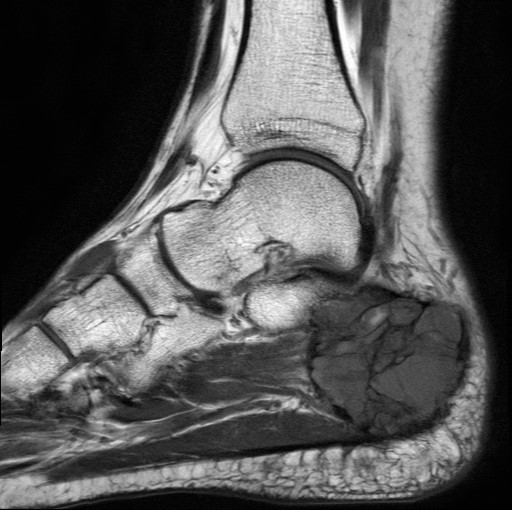 File:Aneurysmal bone cyst of the calcaneus (Radiopaedia 60669-68420 Sagittal T1 13).jpg