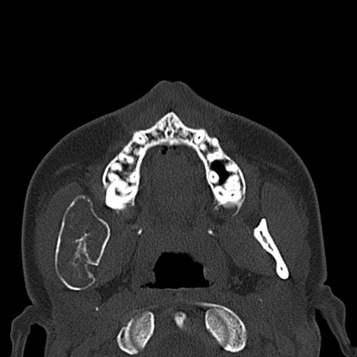 Aneurysmal bone cyst of the mandible (Radiopaedia 43280-46601 Axial bone window 50).jpg