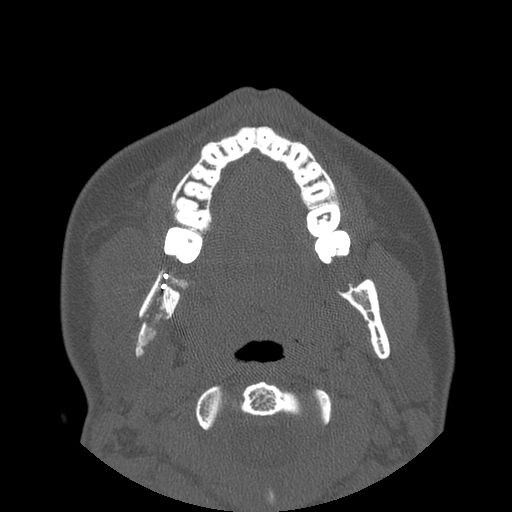 Aneurysmal bone cyst of the mandible (Radiopaedia 43280-46823 Axial bone window 79).jpg
