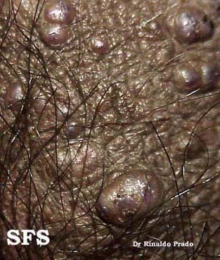Angiokeratoma Of The Scrotum (Dermatology Atlas 4).jpg