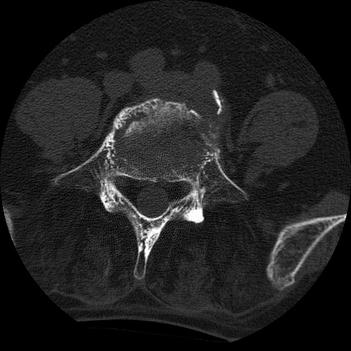 Ankylosing spondylitis complicated by fracture-dislocation (Radiopaedia 33583-34674 Axial non-contrast 126).jpg