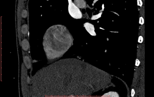 Anomalous left coronary artery from the pulmonary artery (ALCAPA) (Radiopaedia 70148-80181 C 15).jpg