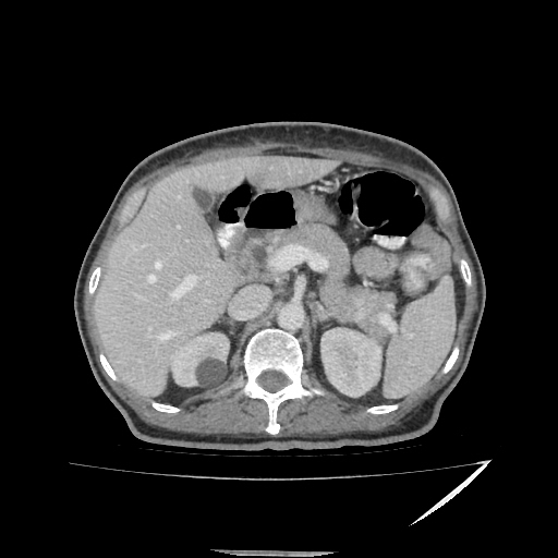 Anorectal carcinoma (Radiopaedia 44413-48064 A 15).jpg