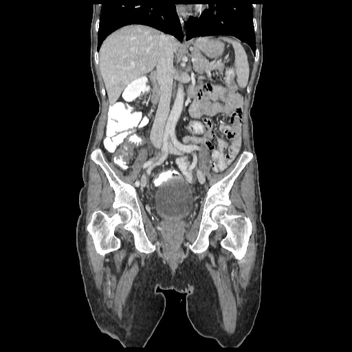 Anorectal carcinoma (Radiopaedia 44413-48064 B 42).jpg