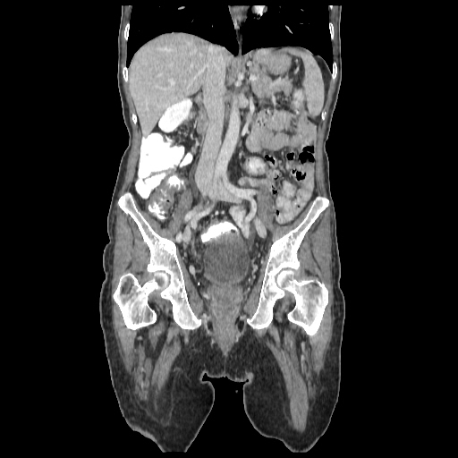 Anorectal carcinoma (Radiopaedia 44413-48064 B 43).jpg