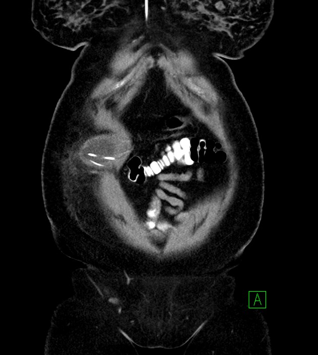 Anterior abdominal wall CSF pseudocyst (CSFoma) (Radiopaedia 79453-92571 B 14).jpg
