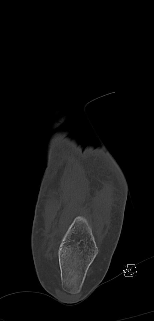 Anterior calcaneal process fracture (Radiopaedia 63353-71943 Coronal bone window 39).jpg