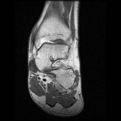 File:Anterior calcaneal process fracture (Radiopaedia 74654-85611 Coronal T1 8).jpg