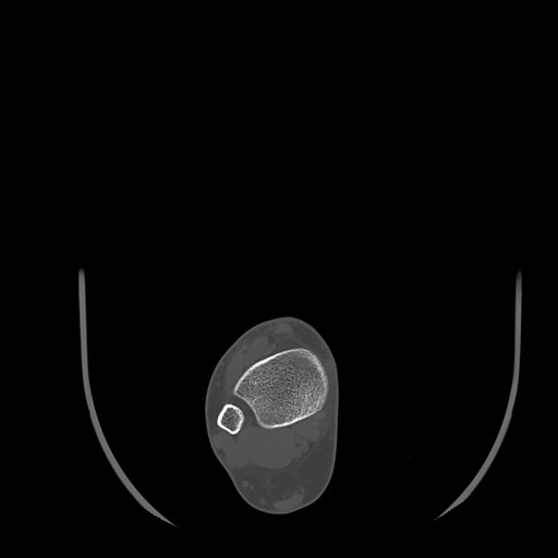 Anterior calcaneal process fracture (Radiopaedia 82590-96762 Axial bone window 5).jpg