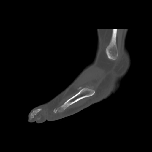 File:Anterior calcaneal process fracture (Radiopaedia 82590-96762 Sagittal bone window 23).jpg